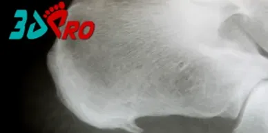 ALIVIAR EL DOLOR ASOCIADO CON EL ESPOLÓN CALCÁNEO
